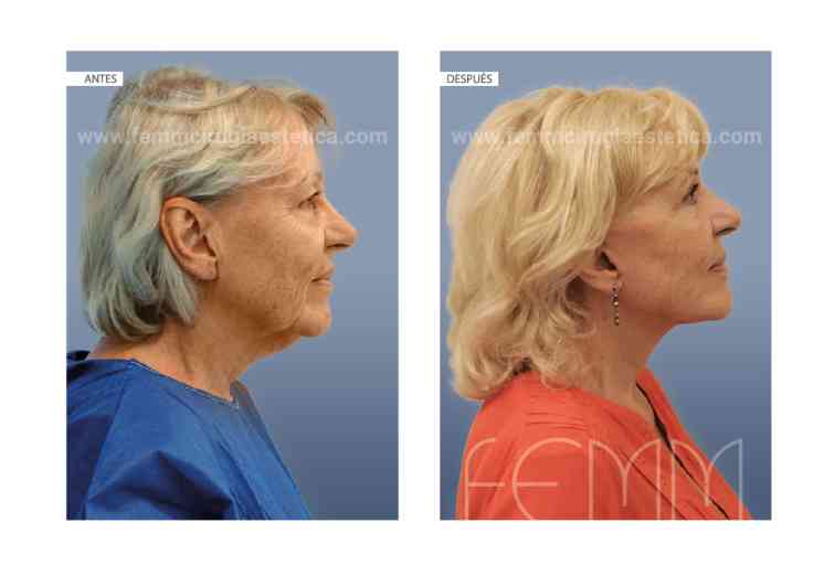 Todo Lo Que Debes Saber Sobre El Lifting Facial Y Cervical Neurat