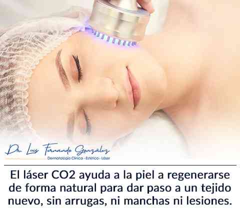 Beneficios del láser de CO2 para rejuvenecer la piel facial - Neurat